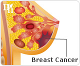 High estrogen levels can cause certain types of cancer like breast cancer.