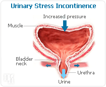 Urinary stress incontinence