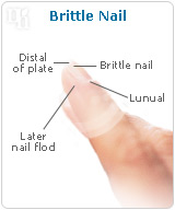 Brittle nail