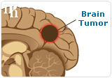  Brain tumor