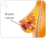  HRT has a higher risk of developing breast cancer and other diseases