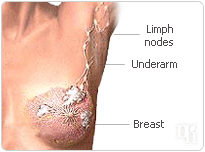 Breast cancer is associated with HRT.