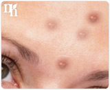 A common cause of acne in adult women is hormonal imbalance.