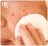 Polycystic  ovarian symdrome can lead to acne.